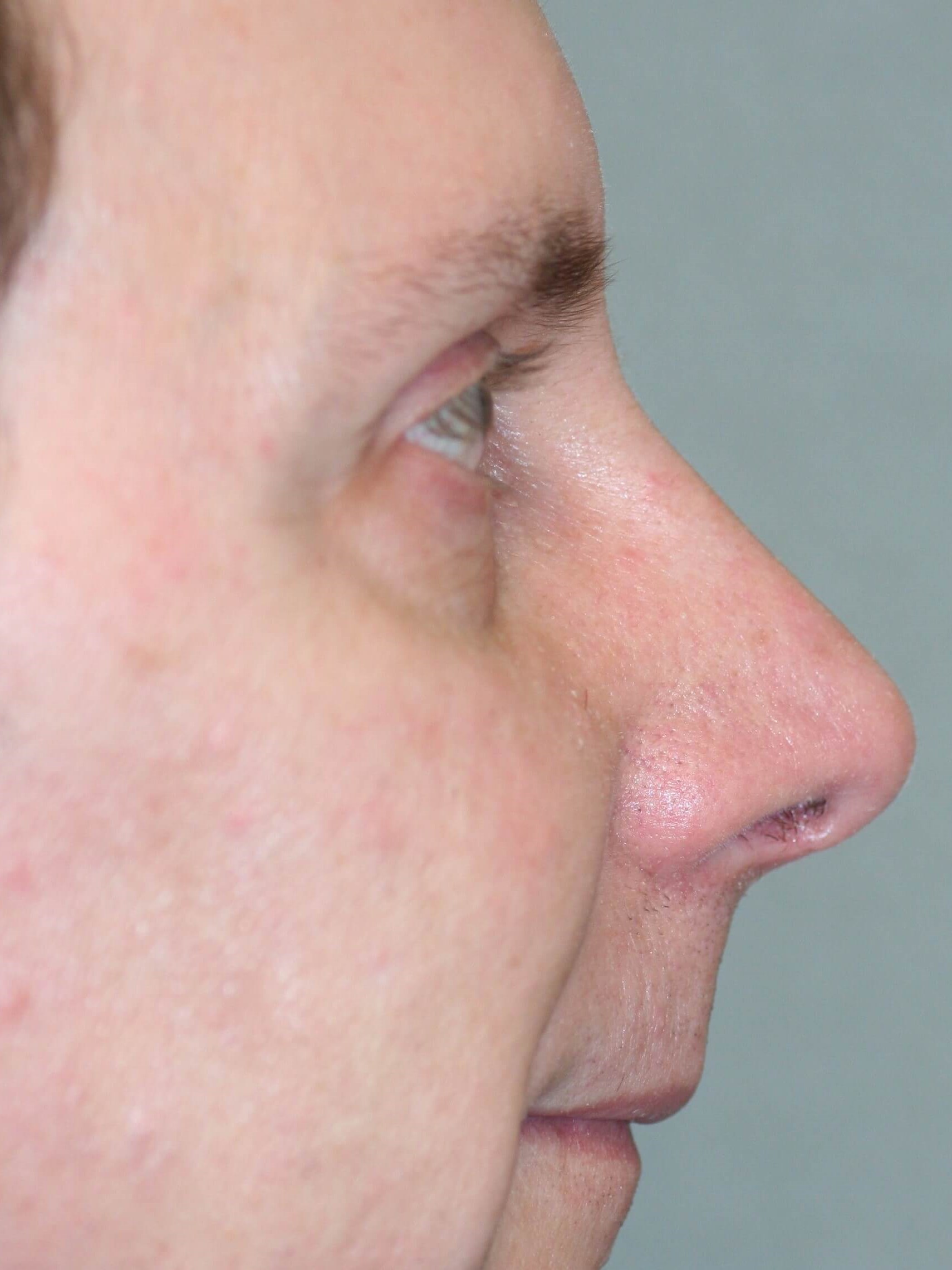 Male Open Rhinoplasty After
