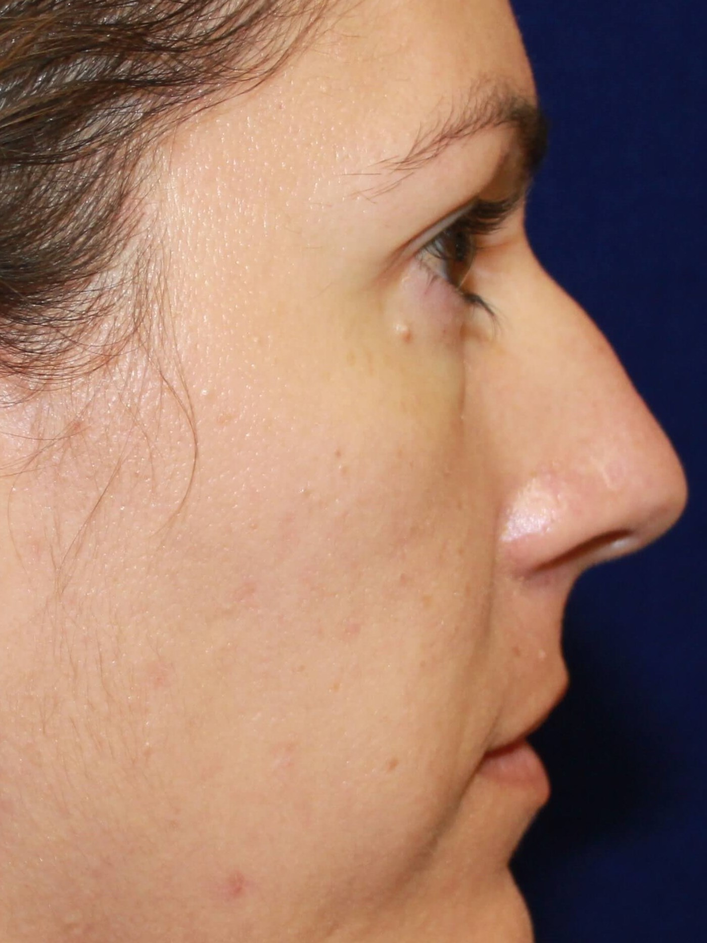 Open Rhinoplasty Before