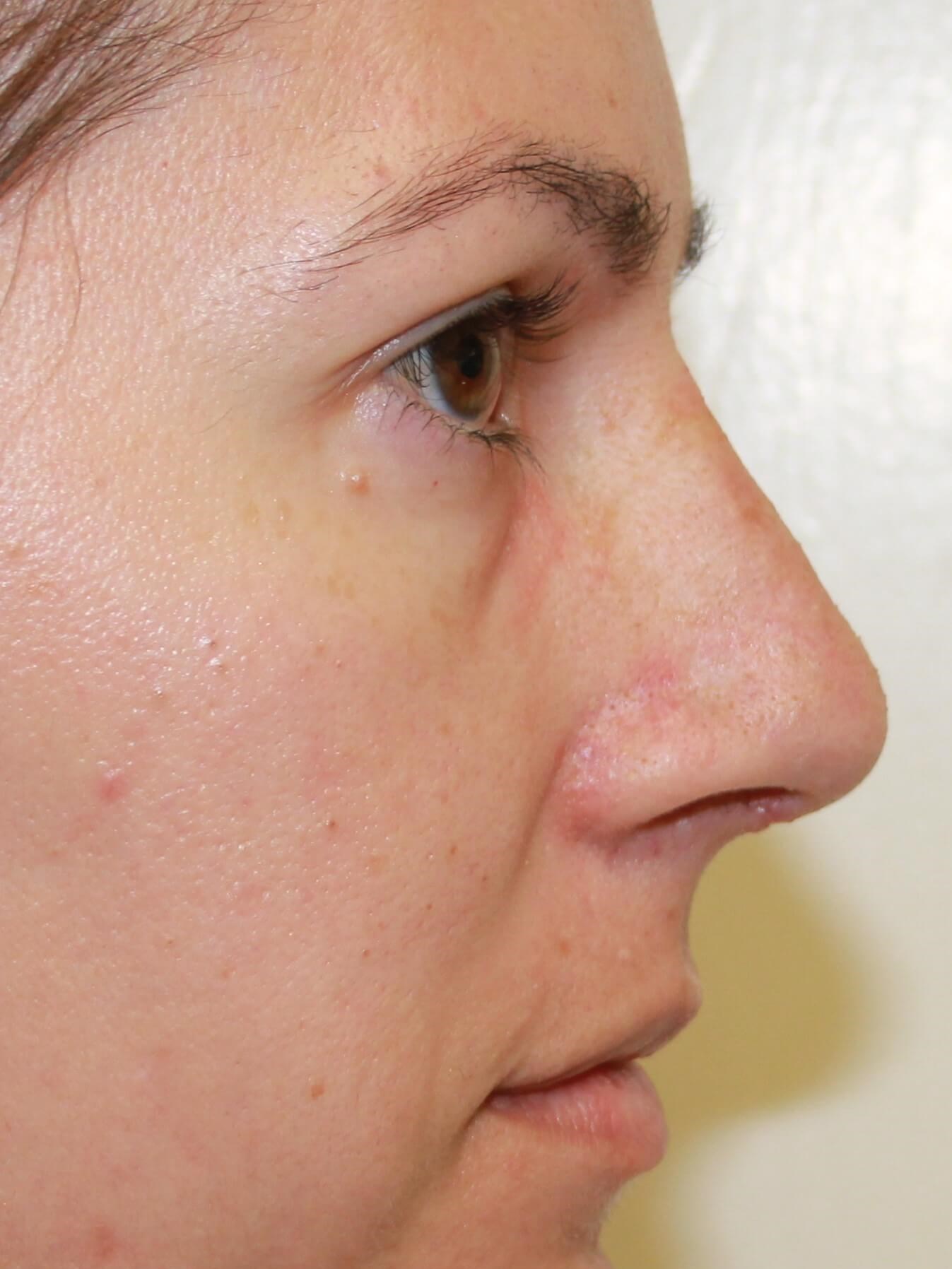 Open Rhinoplasty After