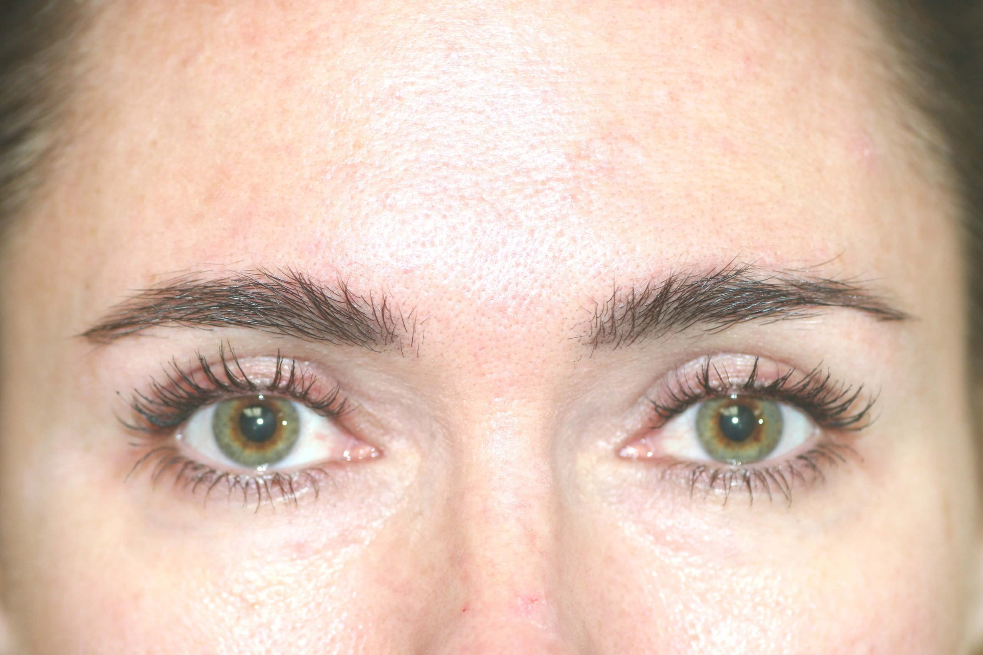 Blepharoplasty After