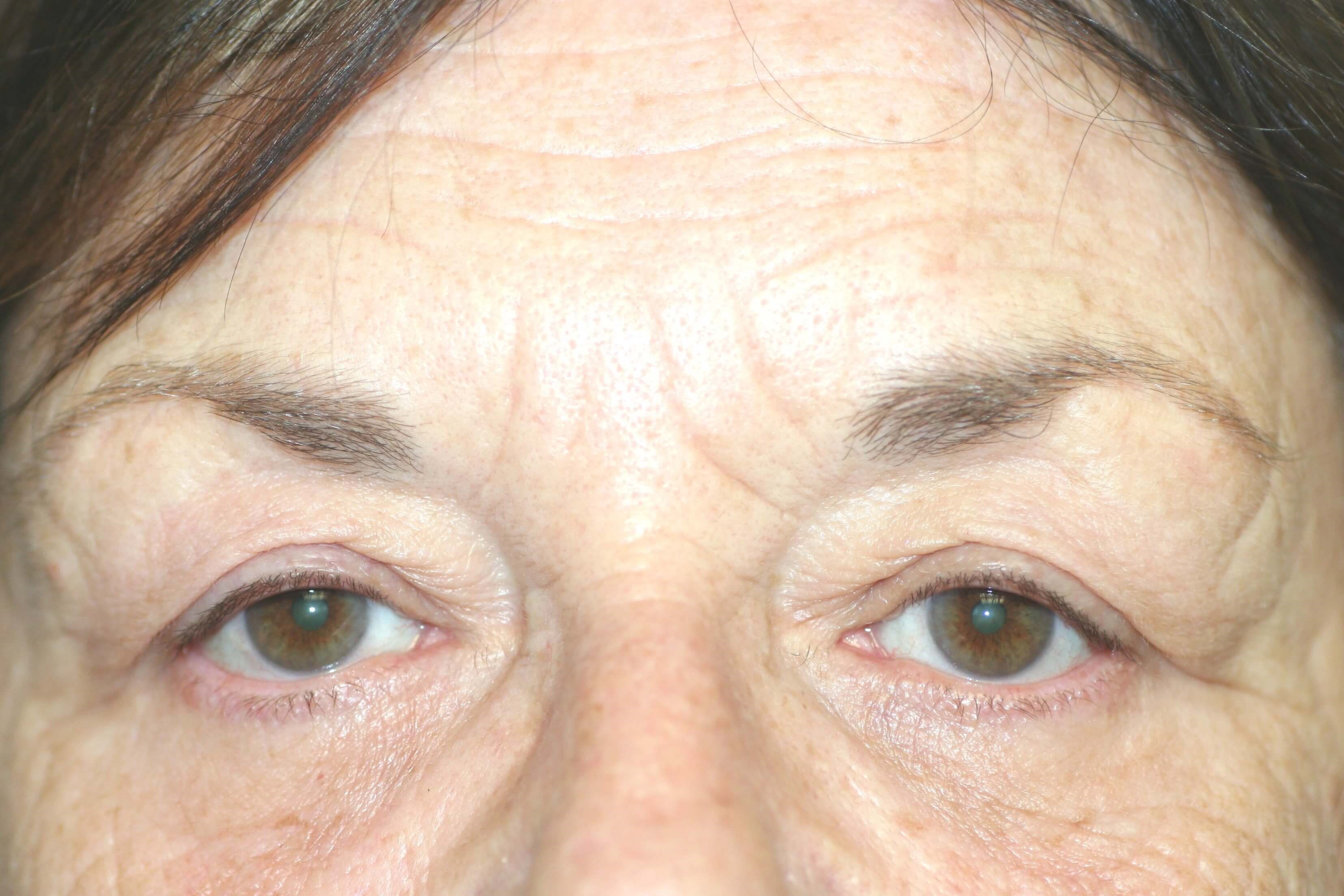 Upper Blepharoplasty Before