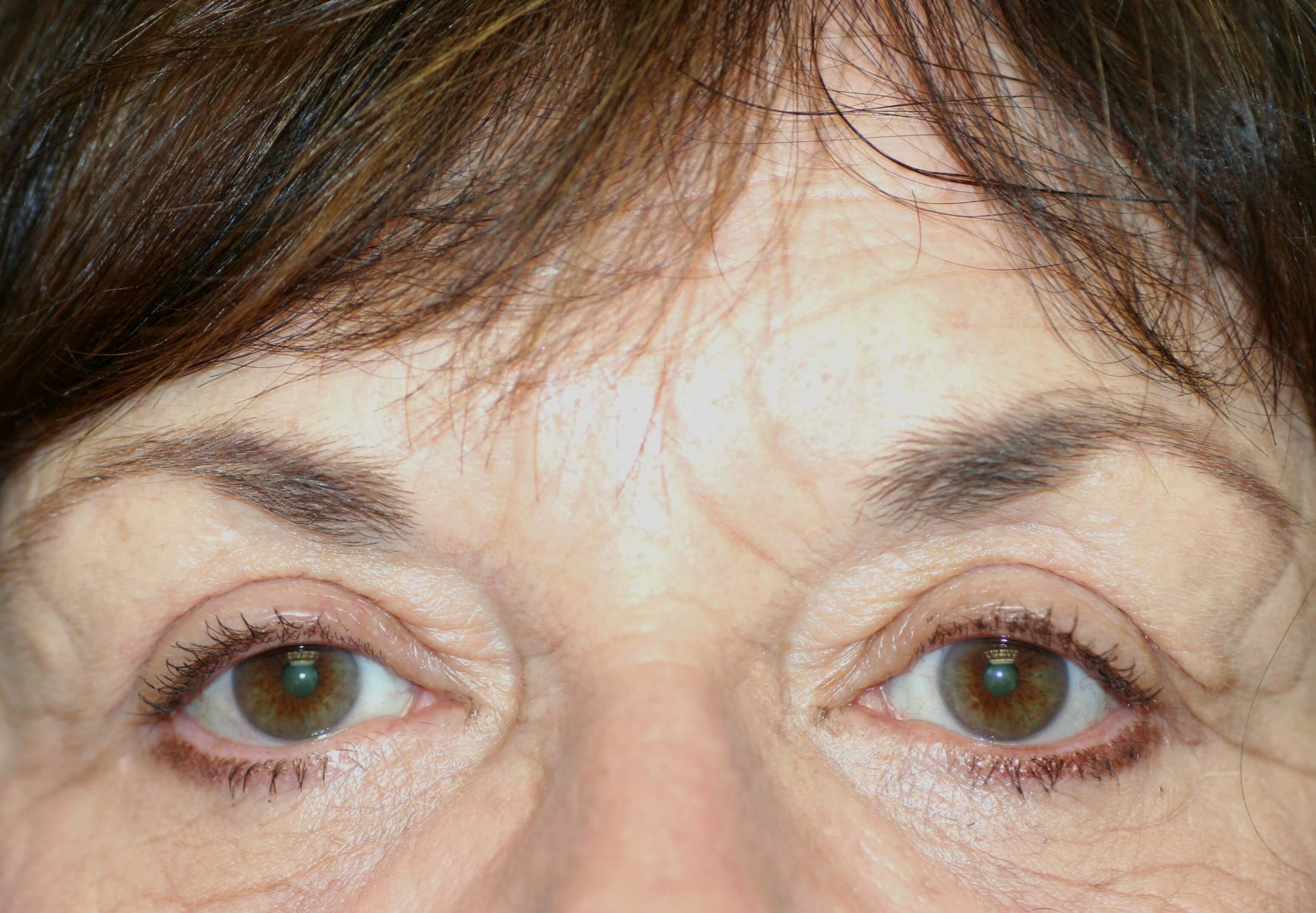 Upper Blepharoplasty After