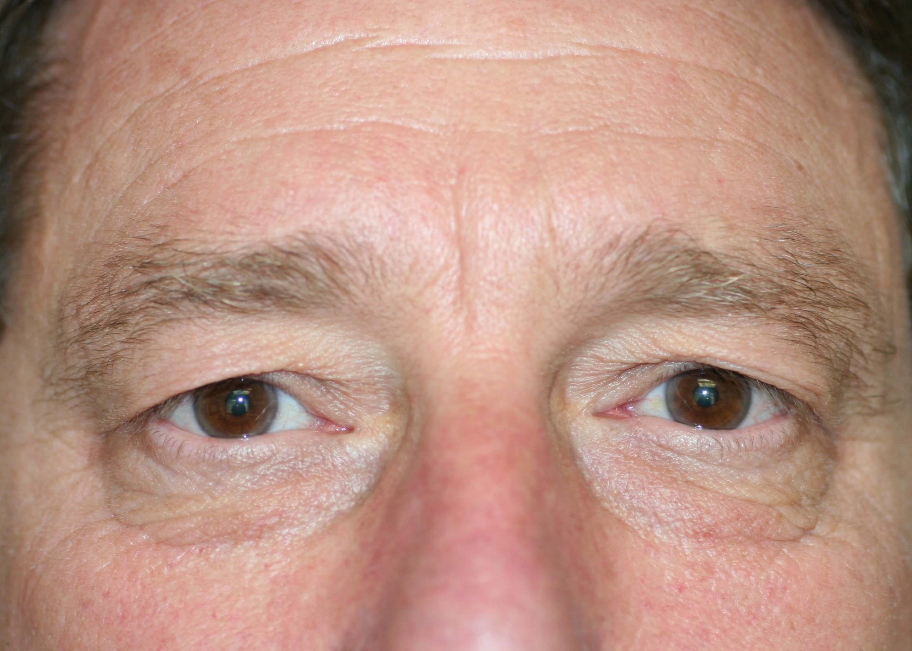 Male Blepharoplasty Before
