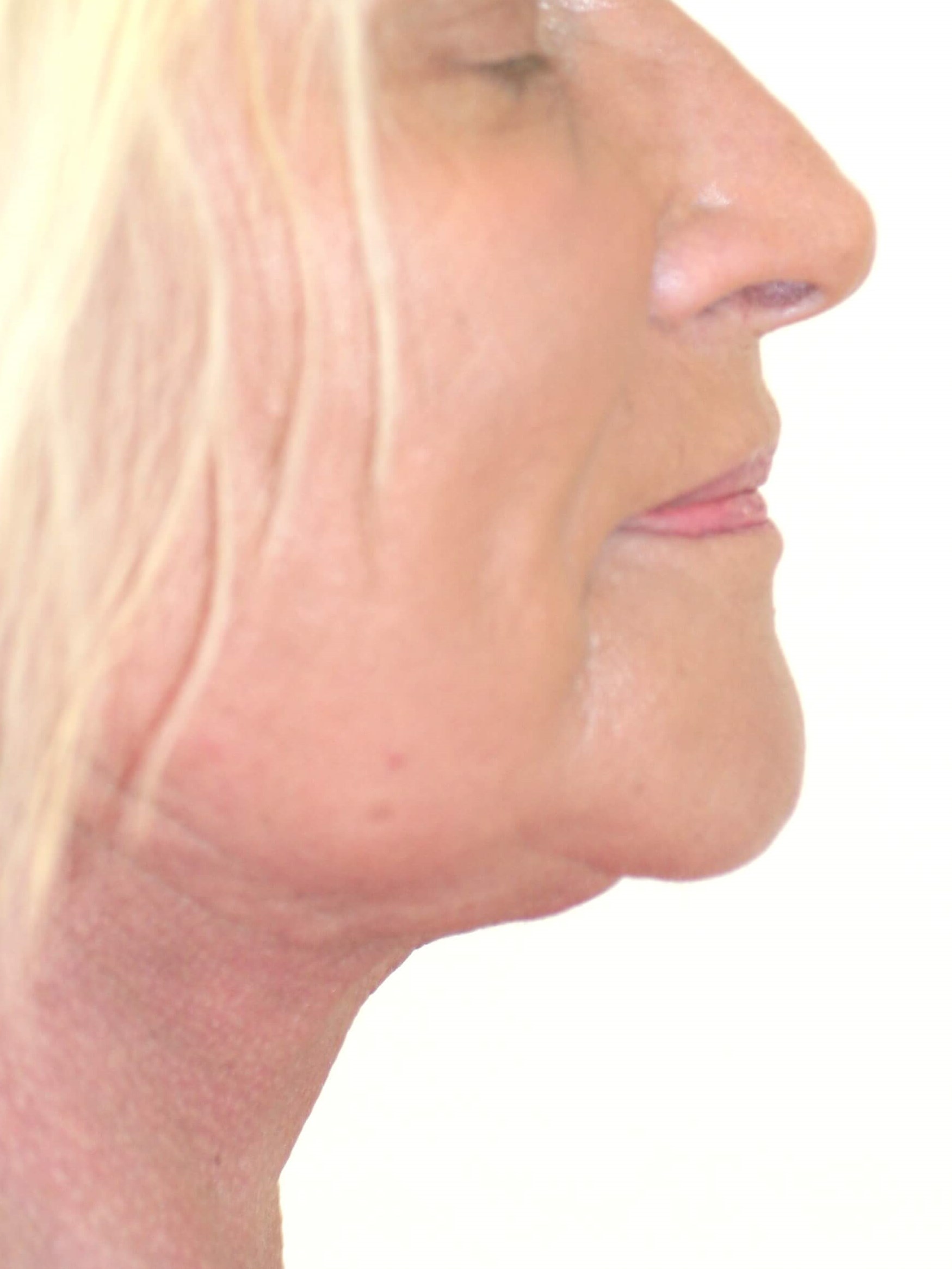 Neck Lift After