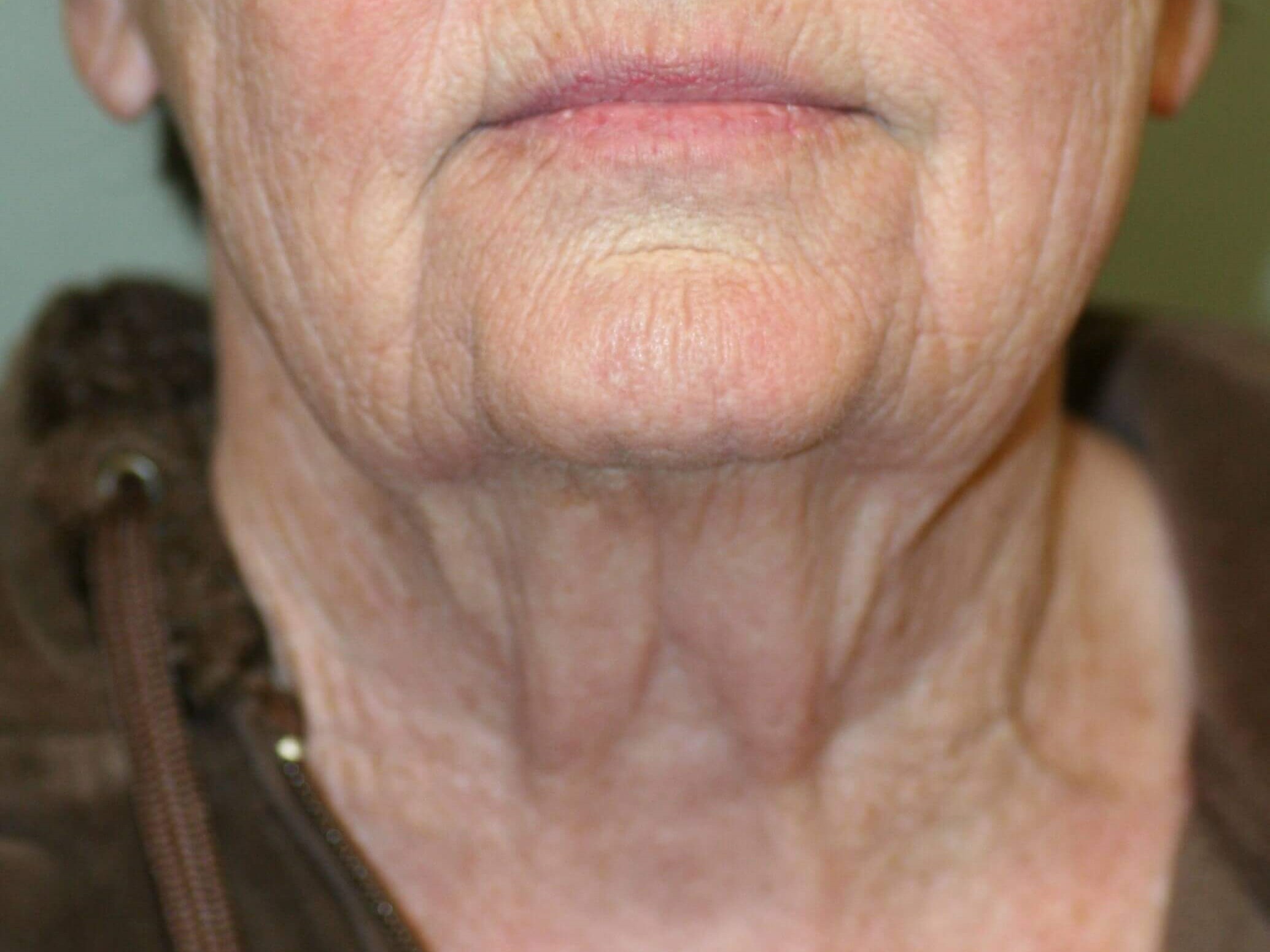 Neck Lift Before