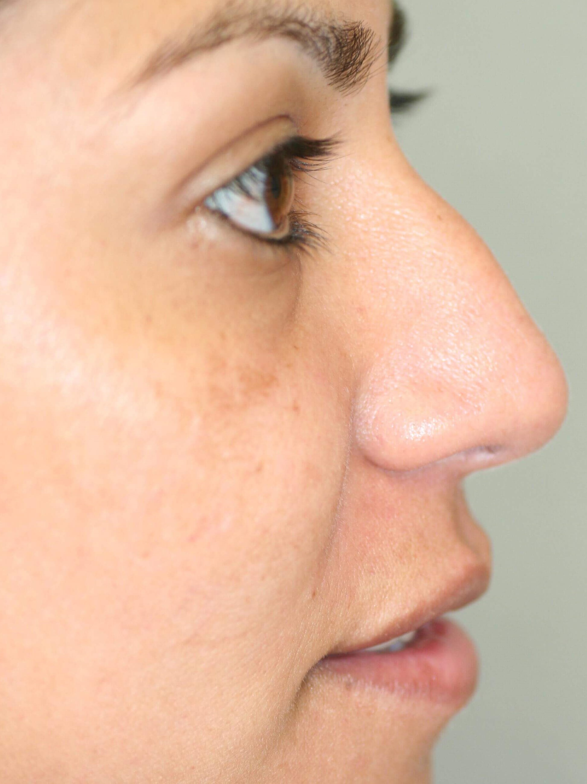Open Rhinoplasty Before