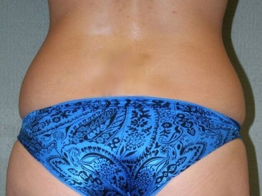 Liposuction Love Handles Before