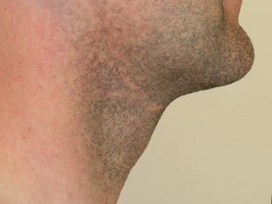 Neck Liposuction After