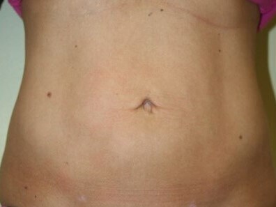 Abdominal Liposuction After