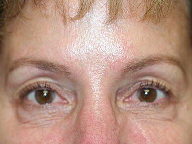 Blepharoplasty Before