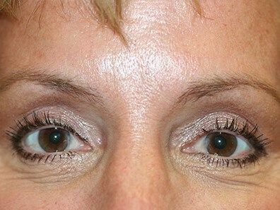 Blepharoplasty After