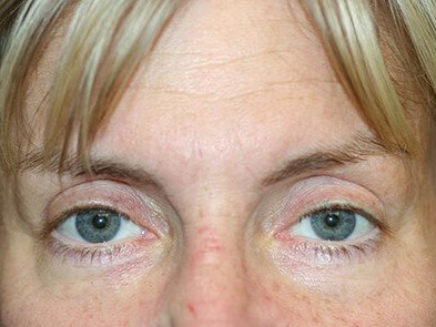 Blepharoplasty After