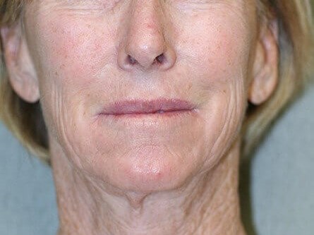 Face Lift Before