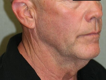 Neck Lift Before