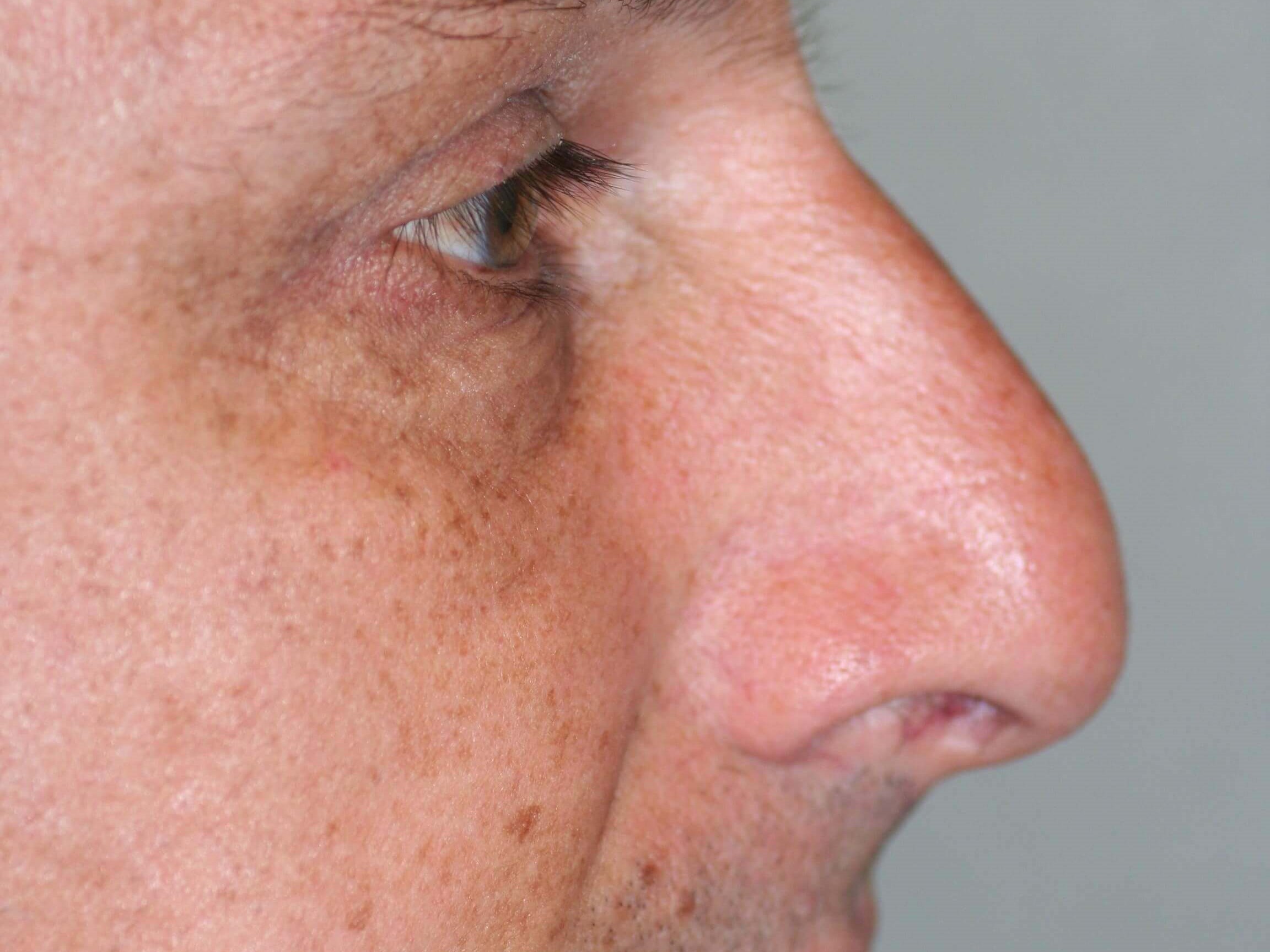 Open Rhinoplasty Before