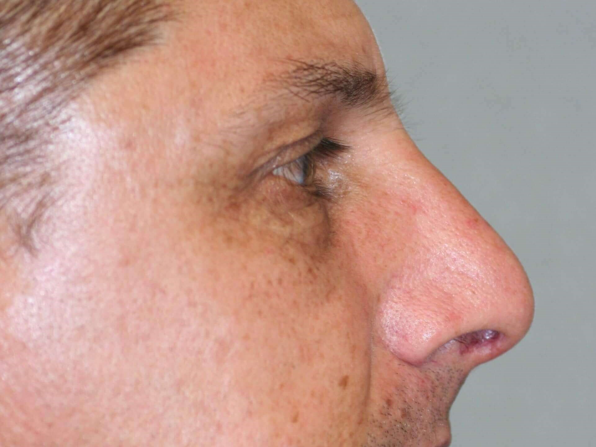 Open Rhinoplasty After