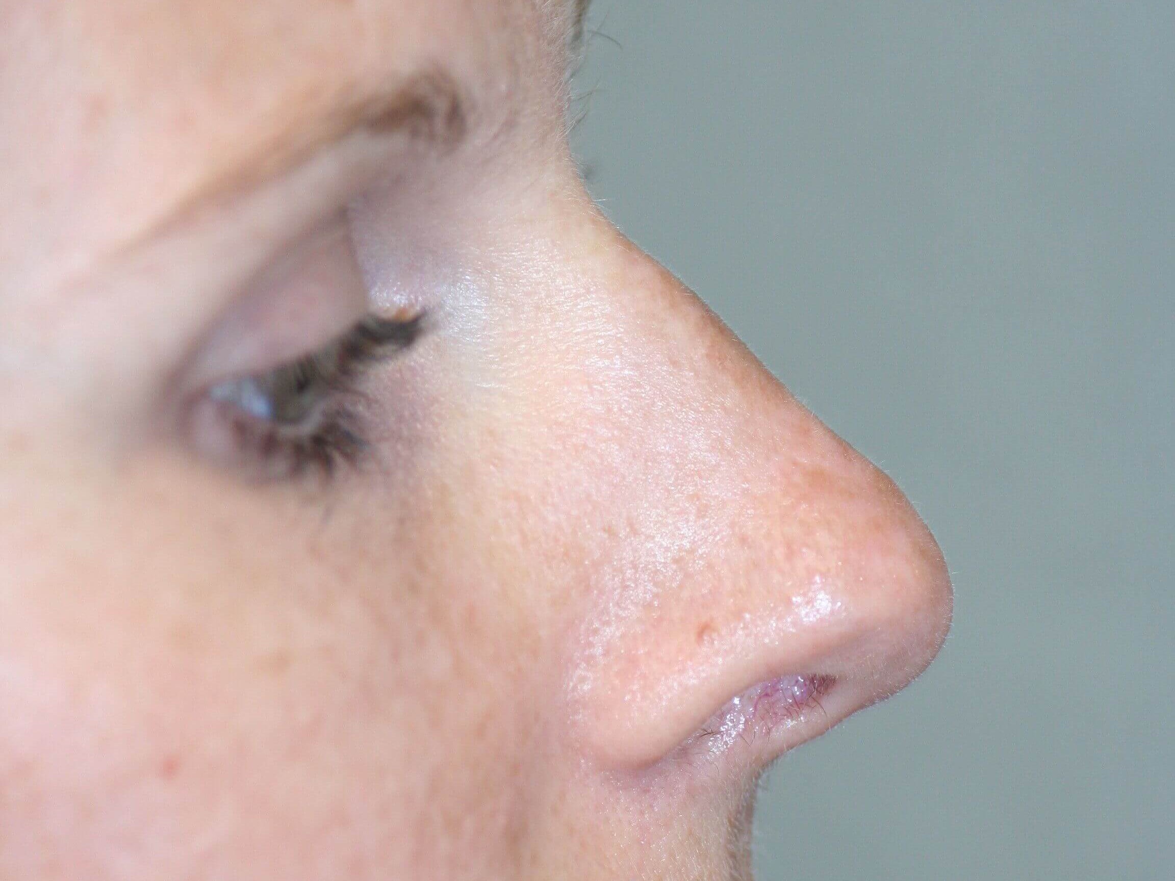Open Rhinoplasty Before