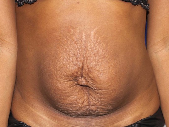 Tummy Tuck Before