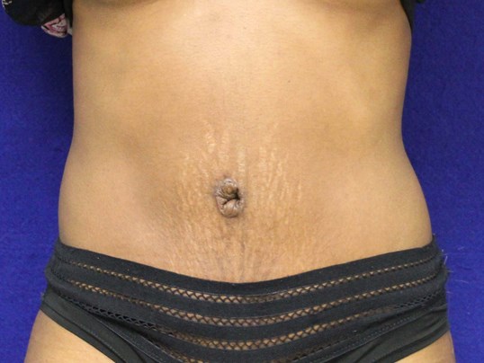 Tummy Tuck After