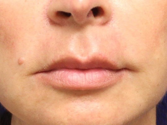 Lip Lift Before