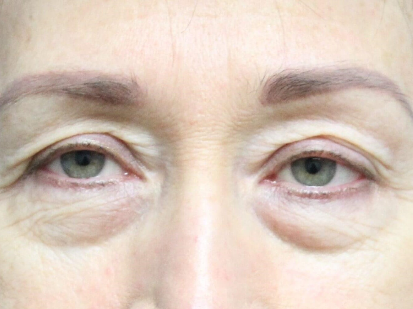 Blepharoplasty Upper & Lower Before