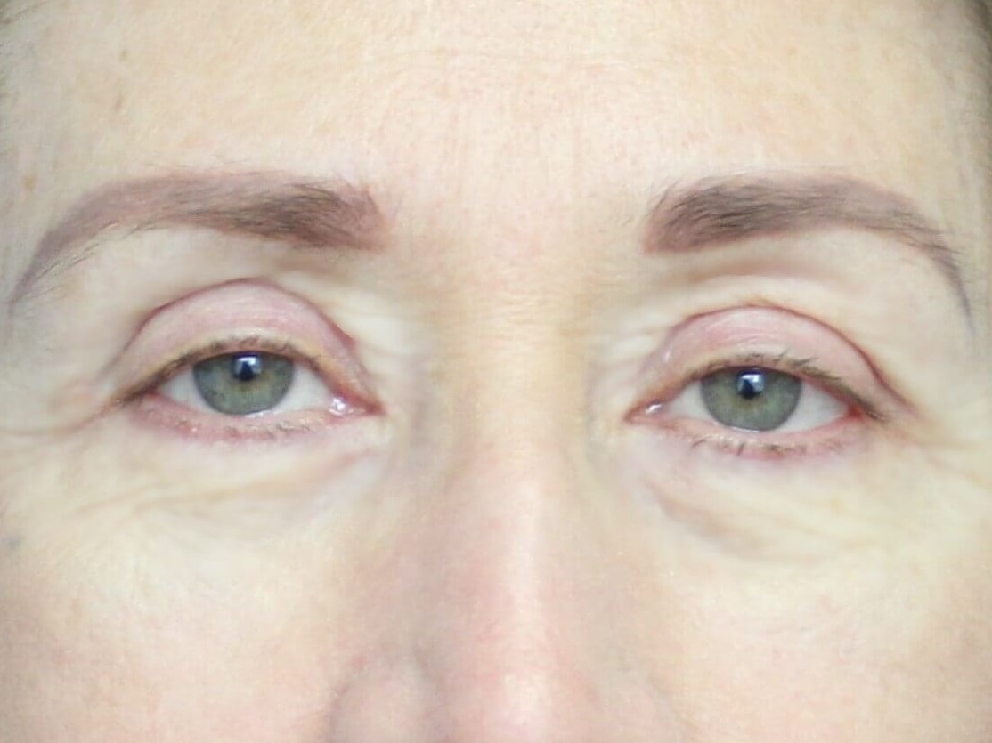 Blepharoplasty Upper & Lower After
