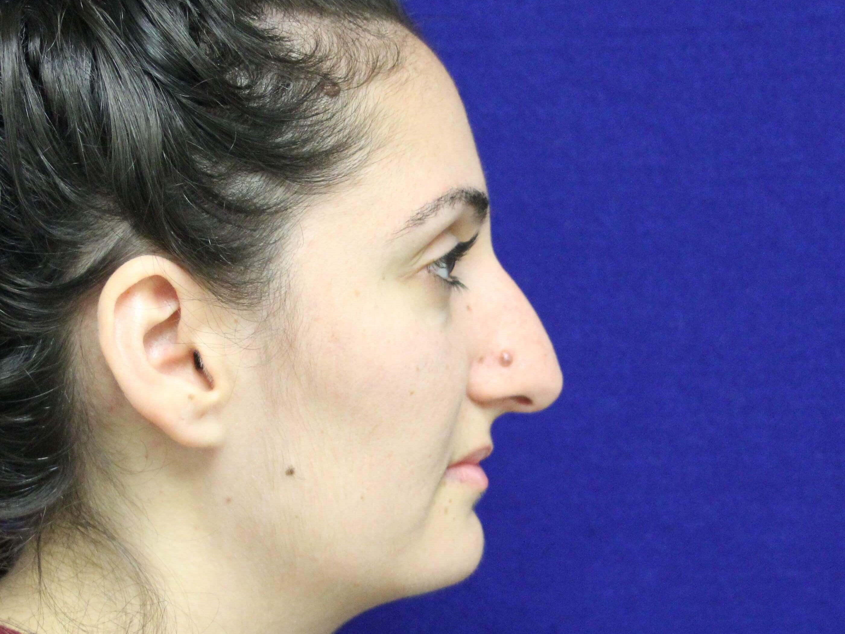 Open Rhinoplasty Before