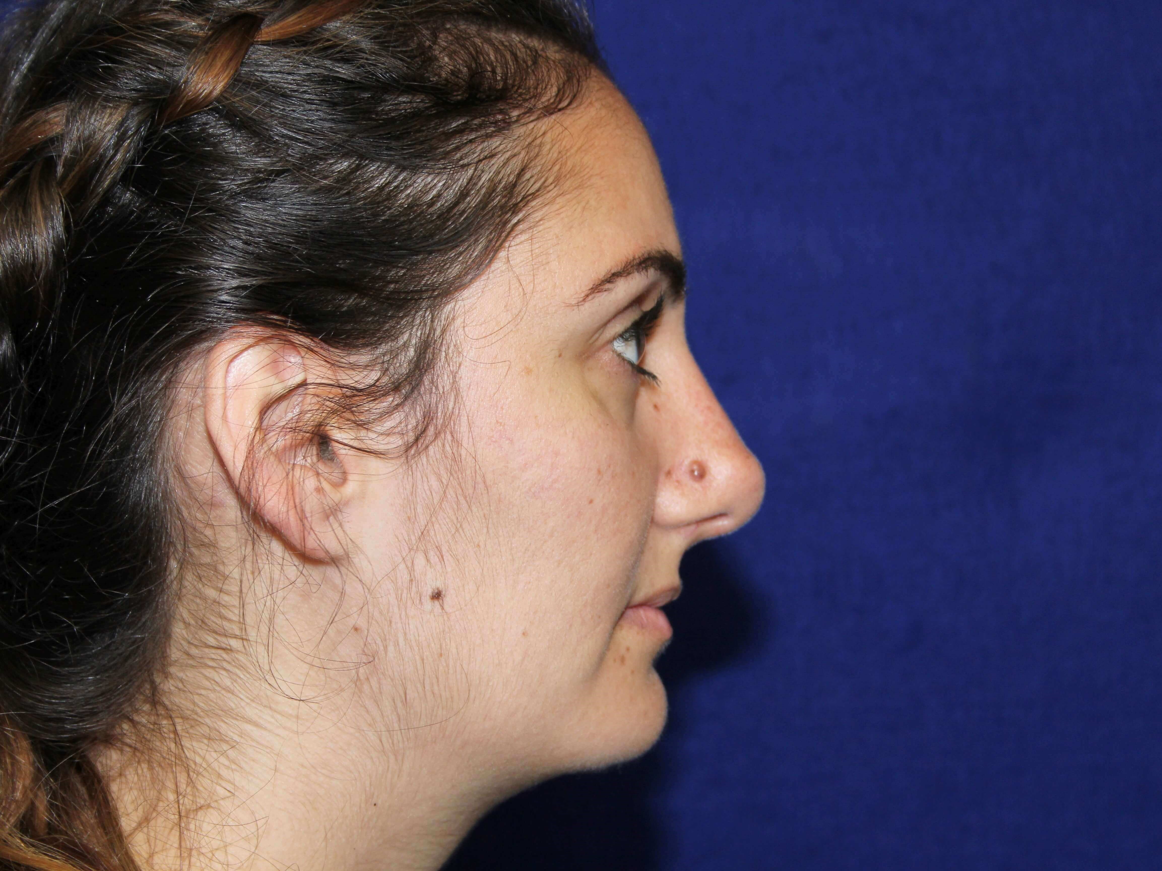 Open Rhinoplasty After