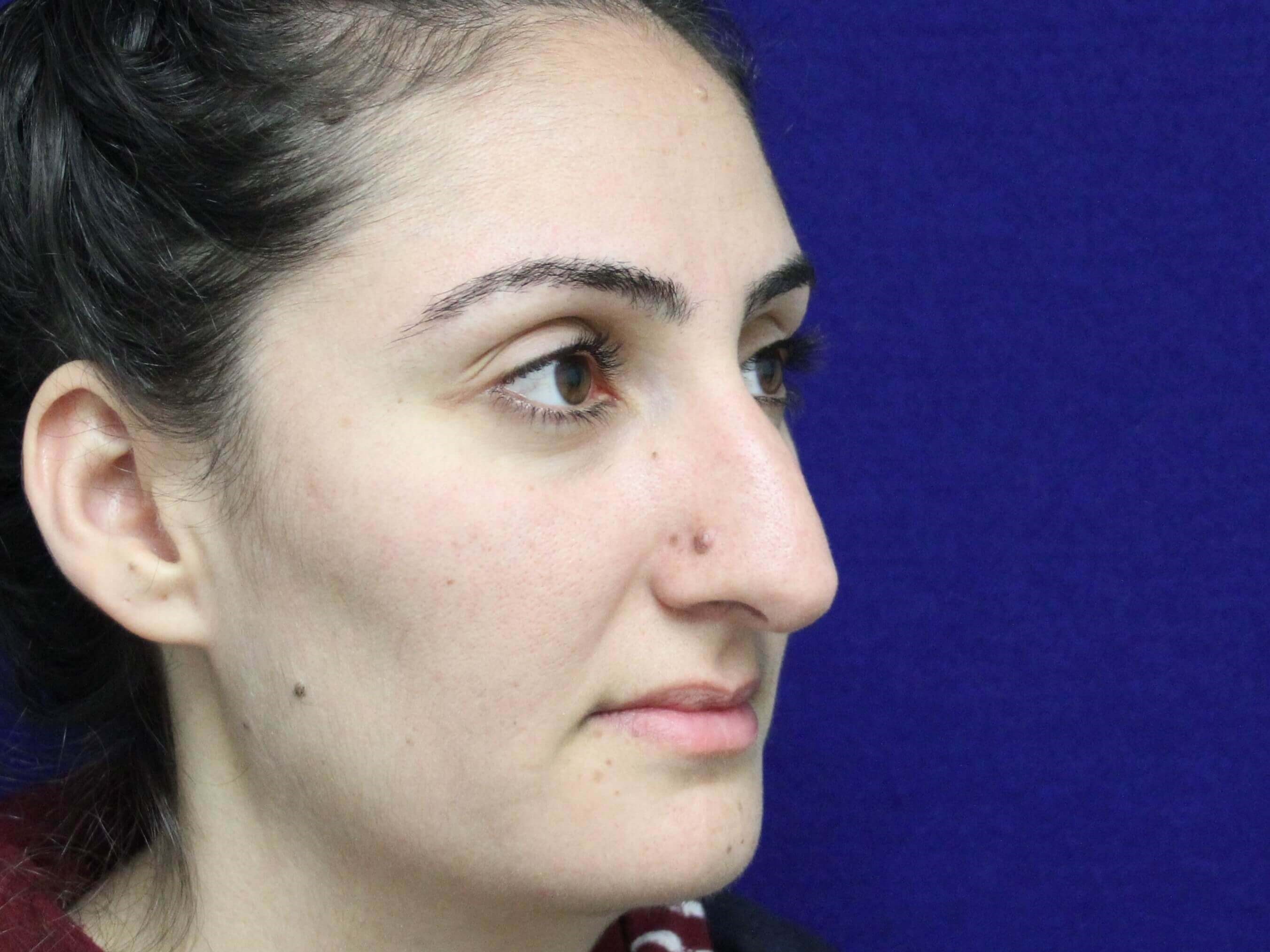 Open Rhinoplasty Before