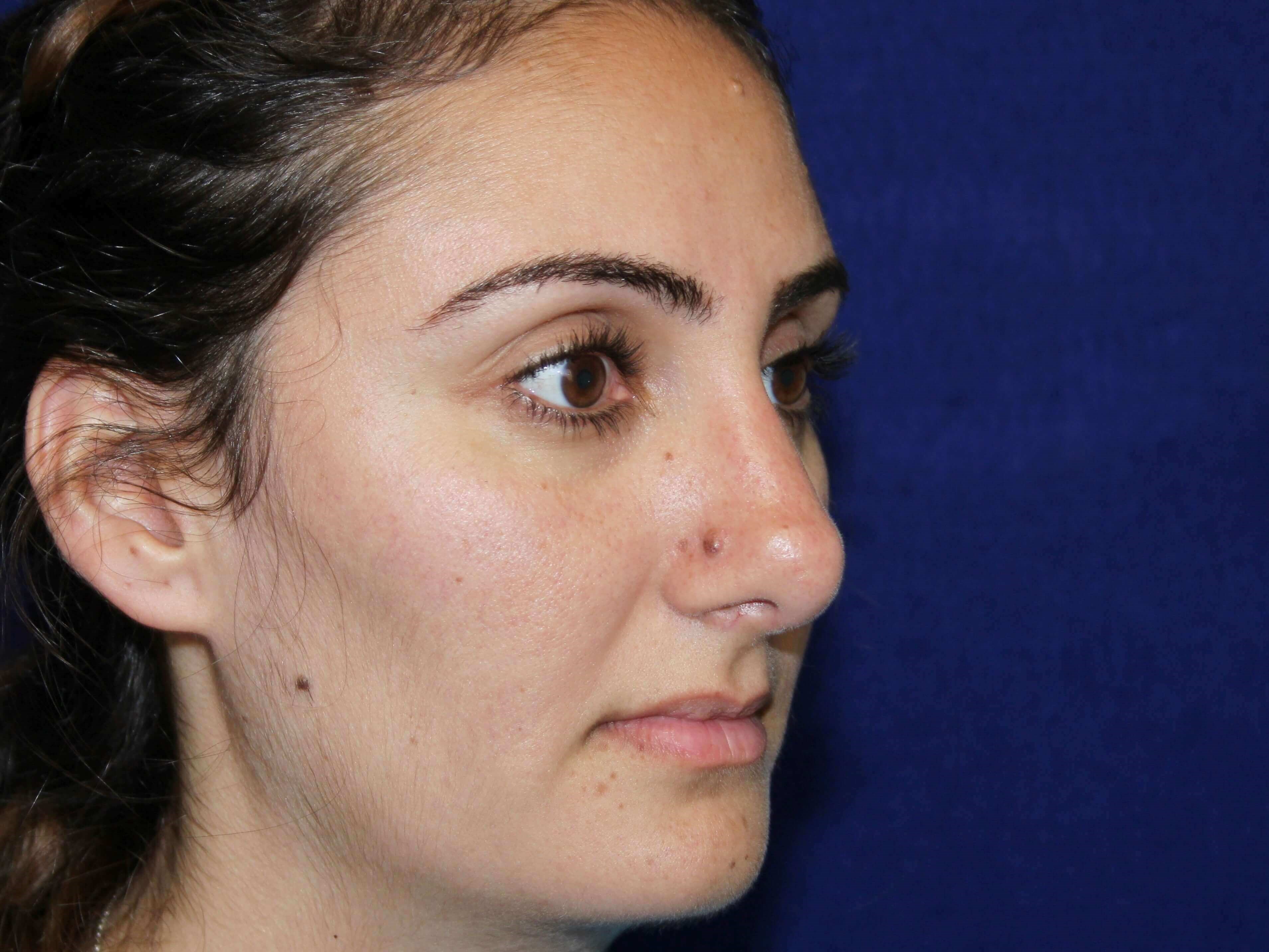 Open Rhinoplasty After