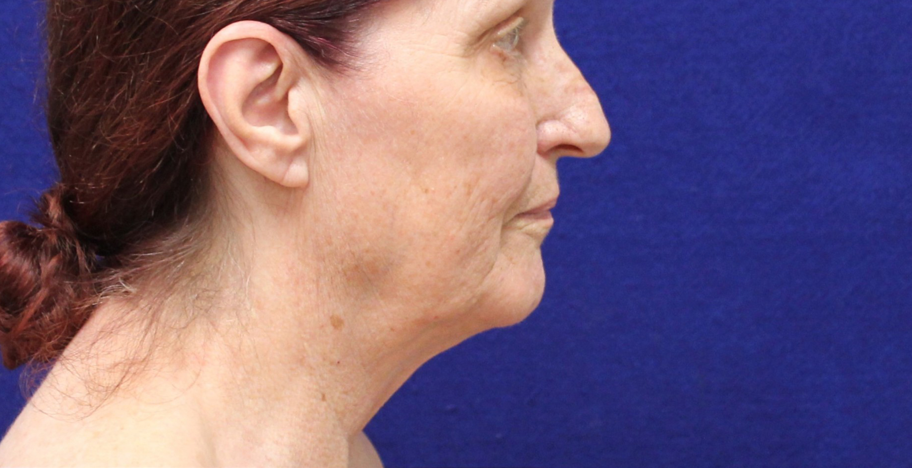 Rhinoplasty & Neck Lift