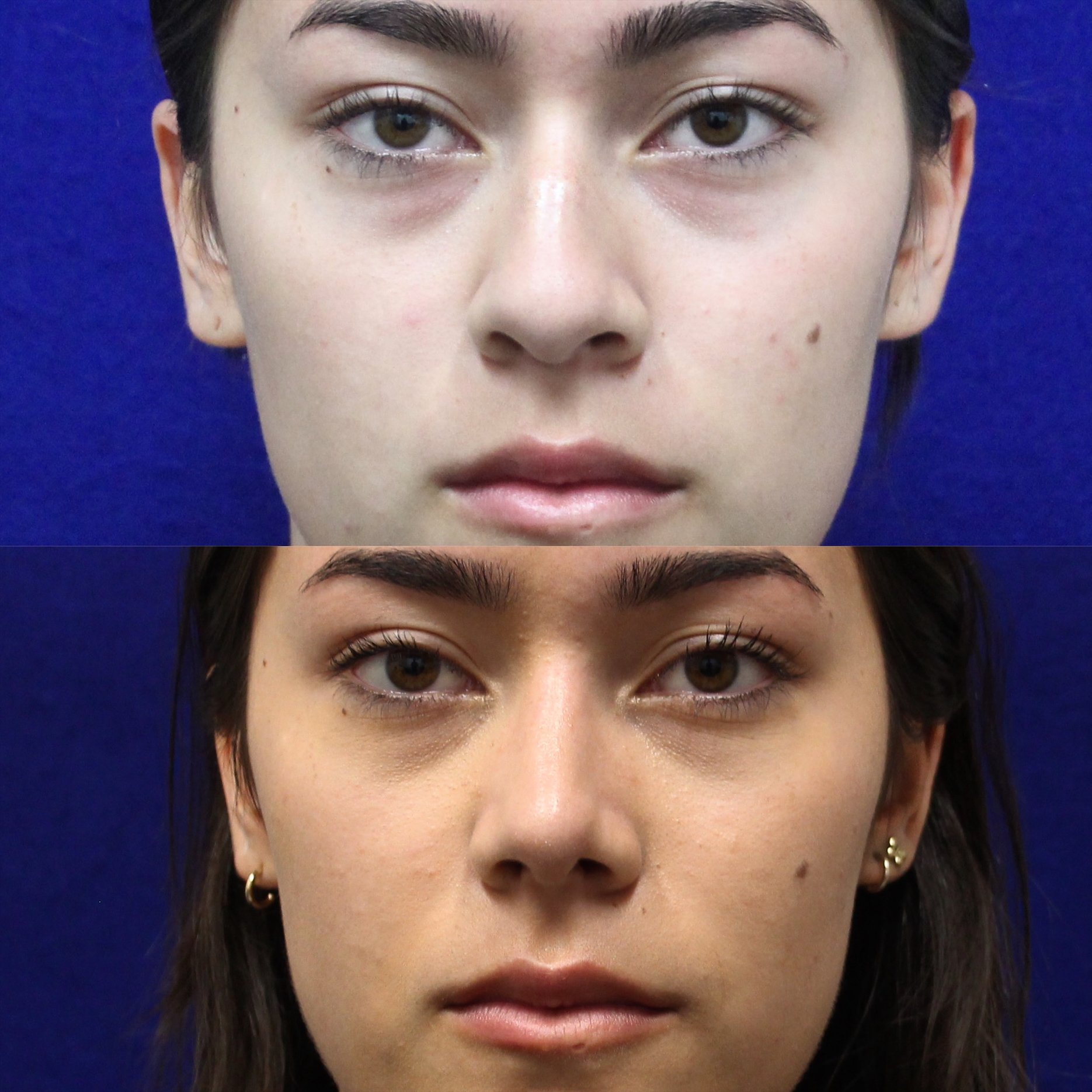 Rhinoplasty & Neck Lift